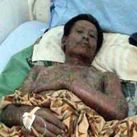 Hilangkan Nyeri karena Pecahan Kaca, Tubuh Wakiman Melepuh