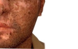 Xeroderma Pigmentosa