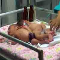 Rahman dan Rahim Akan Dipasang Alat Bantu Buang Kotoran