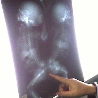 Rahman dan Rahim Dempet Pantat