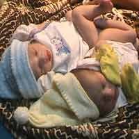 Kembar Siam Dempet Pantat Lahir di Jombang