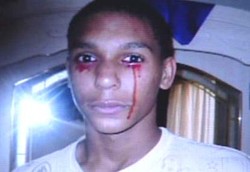  Dokter di Amerika Bingung Deteksi Penyakit Nangis Darah