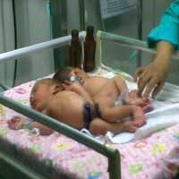 Tim Dokter Pasang Alat Bantu Buang Kotoran 