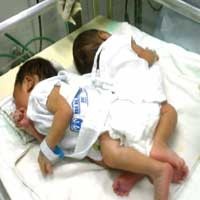 Tim Dokter Kesulitan Membuat Alat Kelamin Bayi