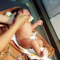 Bayi Tanpa Anus di Madiun Akhirnya Punya Alat Pembuangan 