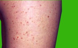 Urticaria Pigmentosa