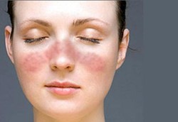  Orang Berkulit Gelap Lebih Berisiko Kena Penyakit Seribu Wajah