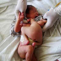 Wanita di Afganistan Melahirkan Bayi Kembar dengan Satu Kepala 
