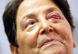 Dengan Gigi Orang Buta Bisa Melihat Lagi