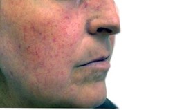 Telangiectasia