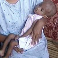 Tak Ada Biaya, Balita Gizi Buruk Dibawa Pulang dari RS