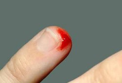 CIPA, Penyakit yang Tak Bisa Merasakan Sakit