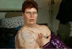 Ganasnya Bakteri MRSA 