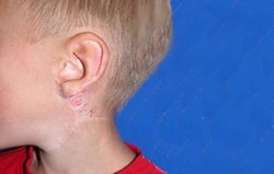 Hemangioma pada Bayi