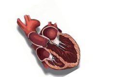 Ischemic Cardiomyopathy