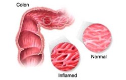Ishemic Colitis