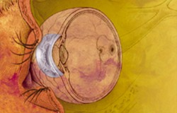 Interstitial Keratitis