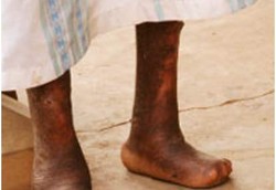 Kusta Bukan Kutukan, Stop Diskriminasi