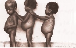 Kwashiorkor