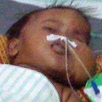 Sejak Lahir, Balita Usia 8 Bulan Alami Tumor Rahang