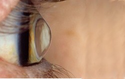 Keratoconus