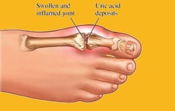 Lesch-Nyhan Sindrome (LNS)