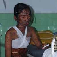 Wanita Berisiko Alami Alergi Obat dan Kulit Melepuh