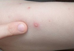 Menangani Anak yang Kena Cacar Air