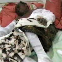 Terhimpit Bara Api 30 Menit, Tubuh Supla Melepuh