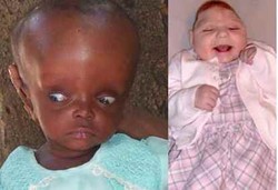 Penyebab Anak Hydrochepalus dan Microcephalus