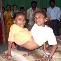 Si Kembar Laba-laba dari India, Berjuang Demi Hidupi Keluarga