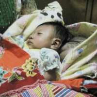 Bayi Berusia 53 Hari Punya Benjolan Lebih Besar dari Kepalanya