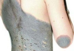 Gadis Kucing, si Penderita Penyakit Kulit Ekstrim 