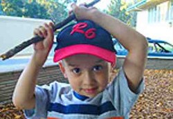 Lengan Titanium Redam Kanker Langka Bocah 3 Tahun