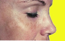 Melasma
