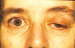Myasthenia gravis 