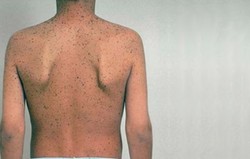 Multiple lentigines syndrome