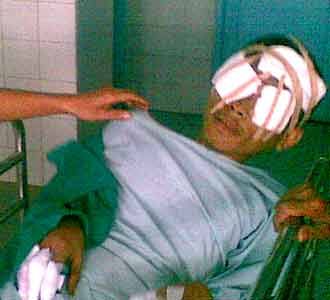 Abda Kehilangan Salah Satu Matanya