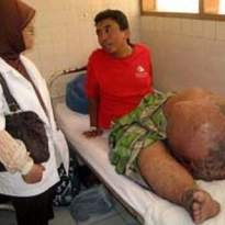 Minum Obat Kaki Gajah, Ratusan Warga Majalaya Dilarikan ke RS 