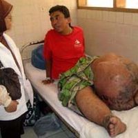 Idap Sakit Keras Bawaan, 3 Orang Meninggal Usai Minum Obat 