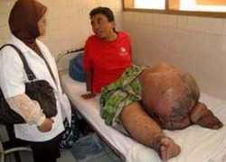 Obat Kaki Gajah Tak Bahaya, Sama dengan Obat Cacing