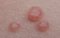 Molluscum Contagiosum