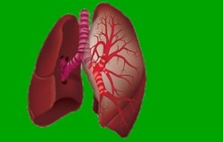 Metastatic Pleural Tumor