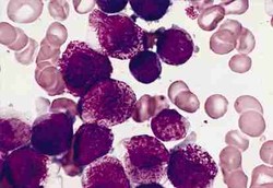 Protein Kanker Bisa Dilumpuhkan