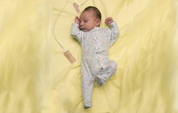 Necrotizing Enterocolitis (NEC)