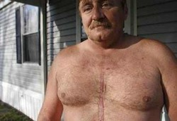 Tak Perlu Dijahit, Operasi Jantung Bisa Menggunakan Lem