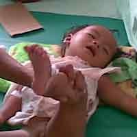 RSD Soewandi Kembali Rawat Pasien Gizi Buruk