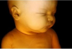 Menentukan Waktu Kelahiran Bayi Berbobot Kecil