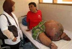 40 Juta Penduduk Indonesia Berpotensi Kena Kaki Gajah