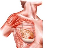 Menanam Bra di Dalam Dada untuk Menaikkan Payudara